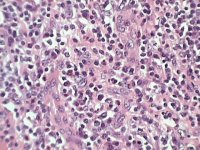 Lymph node H and E; click to enlarge (51K)