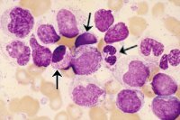 AML with abnormal basophilic morphology; click to enlarge (32K)
