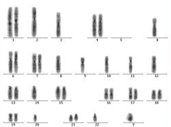 CGH karyotype; click to enlarge (16K)