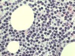 Marrow infiltration by CLL cells; click to enlarge (40K)