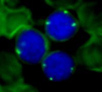 Atypical CLL: Trisomy 12 demonstrated by FISH technique