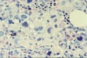 CML megakaryoblastic transformation bone marrow; click to enlarge (39K)