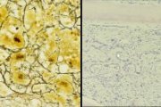 CML megakaryoblastic transformation bone marrow; click to enlarge (46K)