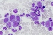 CML chronic phase peripheral blood; click to enlarge (34K)