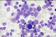 CML chronic phase bone marrow; click to enlarge (39K)