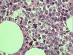 Bone marrow infiltration; click to enlarge (43K)