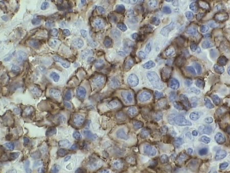 Lymph node stained by CD20 immunoperoxidase