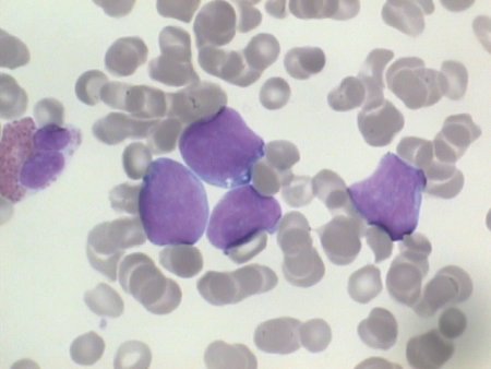DLBCL cells in peripheral blood
