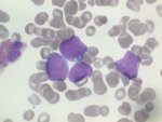 DLBCL cells in peripheral blood; click to enlarge (21K)