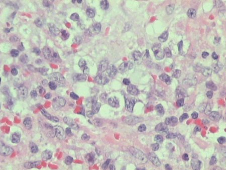 DLBCL cells in lymph node