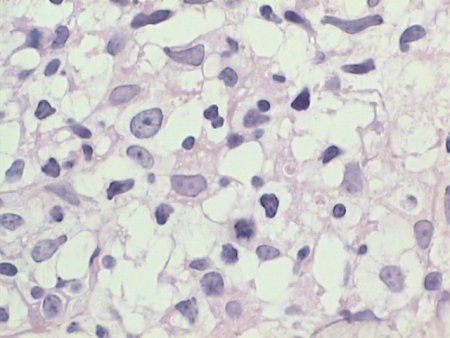 DLBCL cells in lymph node