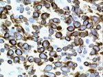 bcl-2 immunoperoxidase; click to enlarge (51K)