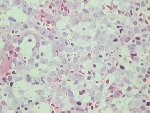 Transformed follicle centre lymphoma; click to enlarge (36K)