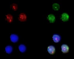 t(11;14) translocation in mantle cell lymphoma; click to enlarge (8K)