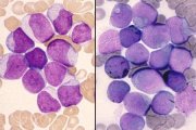 AML-M1 morphology and cytochemistry; click to enlarge (39K)
