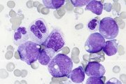 AML-M2 morphology; click to enlarge (31K)