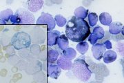 AML-M2 cytochemistry; click to enlarge (30K)