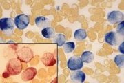 AML-M3 cytochemistry; click to enlarge (30K)