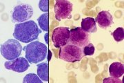 AML-M3 morphology; click to enlarge (30K)