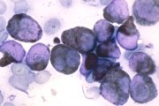 AML-M3 cytochemistry; click to enlarge (26K)