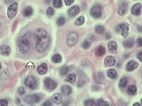 Mixed cellularity HL morphology; click to enlarge (31K)