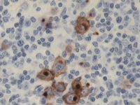 Mixed cellularity HL CD15 stain; click to enlarge (34K)