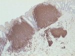 CD20-immunoperoxidase; click to enlarge (38K)