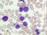 Peripheral blood picture; click to enlarge (44K)