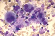 MDS: dysplastic megakaryocytes; click to enlarge (32K)