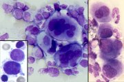 MDS: dysplastic megakaryocytes; click to enlarge (34K)