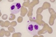 MDS: pseudo-Pelger neutrophils; click to enlarge (18K)