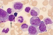 Refractory Anaemia with Excess Blasts; click to enlarge (30K)