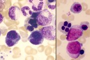 Therapy-related MDS; click to enlarge (27K)