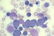 Refractory Anaemia with Ringed Sideroblasts; click to enlarge (26K)