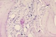 Osteomyelosclerosis bone marrow; click to enlarge (34K)