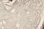 Osteomyelosclerosis bone marrow; click to enlarge (41K)