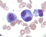 Binucleate plasma cell; click to enlarge (21K)