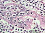MZL lympho-epithelial lesion; click to enlarge (50K)