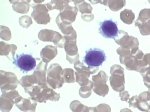 Splenic lymphoma with villous lymphocytes; click to enlarge (23K)