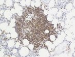 CD20-immunoperoxidase showing nodular infiltrate; click to enlarge (40K)