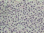 Bone marrow trephine biopsy; click to enlarge (42K)