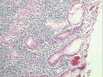 MZL infiltration of stomach mucosa; click to enlarge (53K)