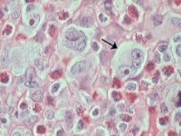 Nodular sclerosing HL morphology; click to enlarge (37K)