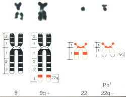 Philadelphia chromosome; click to enlarge (23K)