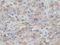Intestinal T-cell lymphoma - CD7-immunoperoxidase; click to enlarge (33K)